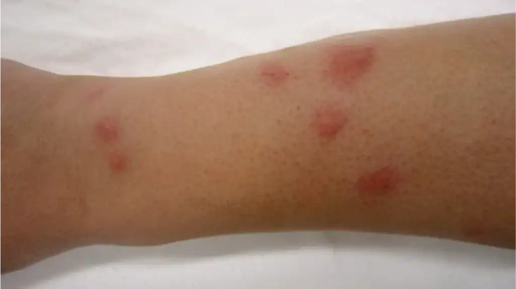 arm with bed bugs bite signs