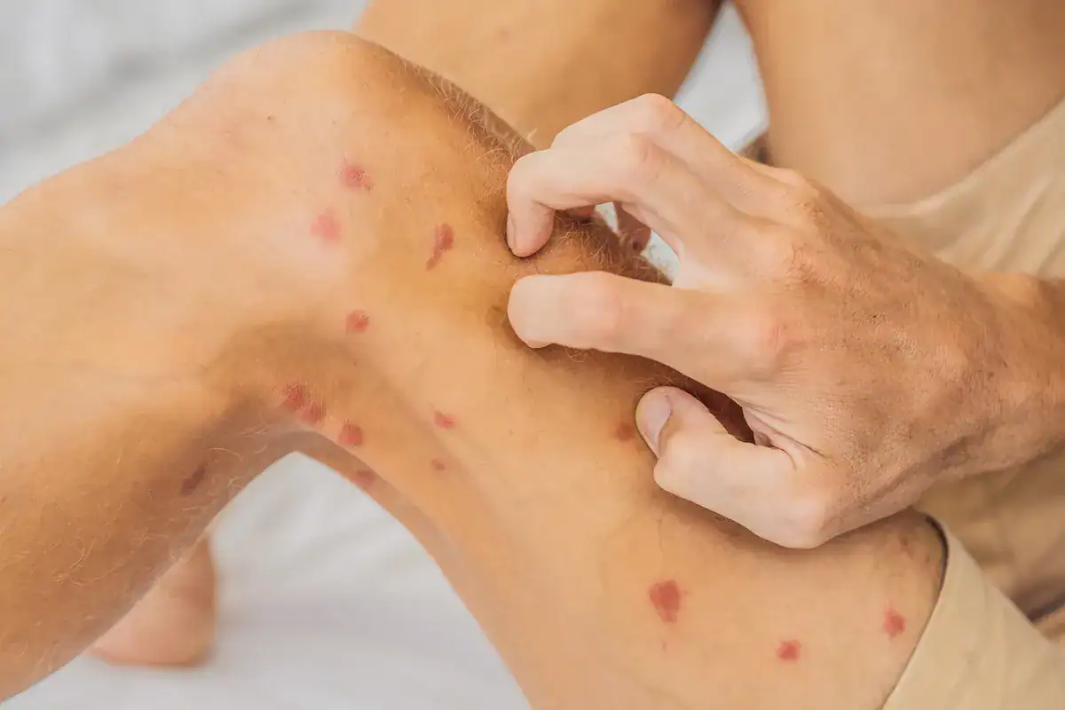 A person’s hand scratching a knee covered in multiple small red, inflamed bumps.